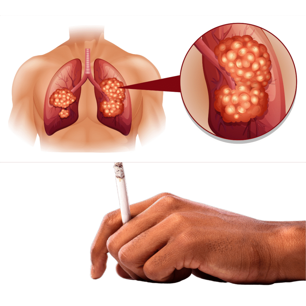 smoker's lungs